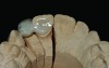 Fig 7. Cantilever single-retainer resin-bonded fixed partial denture made of zirconia (framework) replacing tooth No. 7.