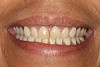 Fig 4. Immediate dentures 3 
weeks postoperative.