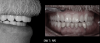 Fig 24. The maxillary denture is placed, and the mandibular telescopic partial is carefully placed and seated.