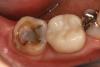 (1.) Example of a clinically challenging second molar preparation that has a limited vertical dimension for the restoration.