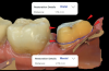 (4.) Occlusal view of a nonretentive, short clinical crown preparation for tooth No. 18 with an overtapered distal margin and short preparation wall height and occlusal and buccal views of the virtual model of the preparation following a digital scan (CEREC®, Dentsply Sirona).