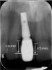 Figure 5 Characterization of the interproximal bone and tooth contacts: A periapical radiograph assists in measuring the distance from bone crest to the adjacent tooth contact points for missing tooth No. 8. The mesial bone crest to the adjacent tooth con