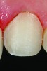 Fig 11. Close-up of the conservative Class III veneer preparation design showing facial reduction of 0.5 mm to 1 mm on the tooth.