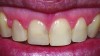 Fig 1. 45-year-old female with esthetically unpleasant direct composite veneer on tooth No. 8.