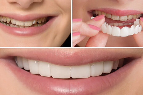 Manufacturing Snap-On Smiles for Functional and Cosmetic Restorative Solutions