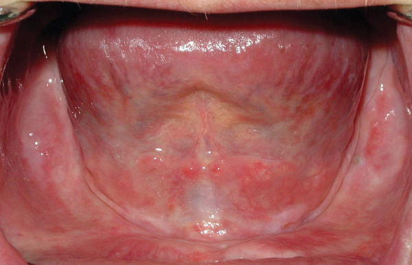 Treatment Planning Decisions Bar Overdenture Versus Freestanding