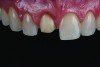 Fig 5. One-week follow-up of feldspathic porcelain veneer on tooth No. 8.