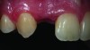 Fig 6. 17-year-old female with missing tooth No. 7 and intact adjacent teeth.