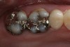 Figure 2  Preoperative occlusal view of teeth Nos. 2 and 3.