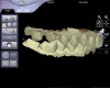 Figure 6  Digital models aligned in maximum intercuspation based on the buccal scan.