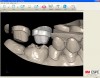 Figure 10  The digital impression data is input to the program for design and milling of the zirconia coping and digital veneer.
