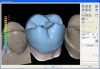 Figure 11  Full-contour crown design.