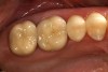 Figure 17  Occlusal view of cemented crowns for teeth Nos. 2 and 3.