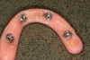 Figure 4  A modified, screw-retained provisional.