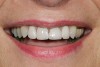 Figure 1  A magnified 1:2 view of the patient’s smile shows bilateral disharmonies as the patient smiles with medium lip dynamics.