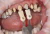 Figure 2  The stump shape against the preparation tooth indicates the tooth structure to be worked on