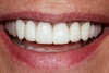 Figure 3  Images of provisionals allow the technician to evaluate the interaction of maxillary incisal images with soft tissue.