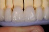 Figure 9: After baking, the crowns were positioned and verified with a silicone index to ensure they were of equal length.