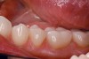Figure 18  A view of the lower crowns’ buccal aspect illustrates the natural blend of monolithic IPS e.max with the adjacent teeth.