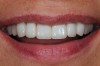 Figure 19  The patient’s final smile several weeks after placement.