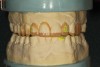 Figure 13  The additive-reductive model was completed by adding wax to the negative areas.