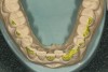 Figure 14  The mandibular preoperative model was reduced so that the restorations being fabricated on the maxillary arch could conform to the proper curves.