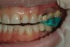 Figure 17  A left CR repeatable bite was recorded and marked with an “L.” A right CR repeatable bite was then recorded and marked with an “R.”