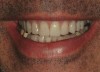 Figure 21  View of the maxillary provisionals in a natural smile.