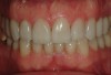 Figure 32  View of the bonded IPS e.max restorations on the 10 upper anterior teeth