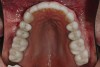 Figure 39: Maxillary postoperative view of the IPS e.max restorations.