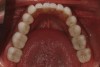 Figure 40  Mandibular postoperative view of the IPS e.max restorations.