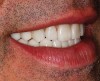 Figure 41  Right lateral view of patient’s postoperative natural smile.