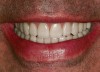 Figure 42  Left lateral view of patient’s postoperative natural smile.