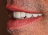 Figure 43  Patient’s postoperative natural smile.