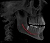 Figure 3  Implant placement planning.