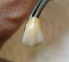 Figure 2  Artificial dentition was individually cut back and stained prior to positioning in wax.