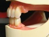 Figure 14  The left side of the maxillary and mandibular anterior dentition.