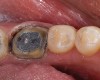 Figure 4  Image of preparation with poor substrate and subgingival margins where maintaining seal would be difficult. High-strength ceramics or metal ceramics would be indicated.