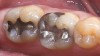 Figure 7  Preoperative photograph of an inlay in tooth No. 18 and an onlay on tooth No. 19.