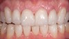 Figure 10  Postoperative photograph after Category 2 materials were applied, with minimal porcelain layering in the incisal one third.