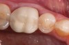 Figure 15  Preoperative image of old PFM. The patient was unhappy with the opacity and metal display at margin. Category 3 or 4 material is required for this case.