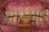 Figure 4  Interocclusal registration made at the approximate OVD for rehabilitation.