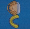 Figure 13  Initial matrix for mandibular rehabilitation. Anterior teeth may be provisionalized using the occlusal surfaces of the posterior teeth as stops.