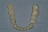 Figure 25  The provisional is segmented based on how the case is to be impressed and how the interocclusal record is to be fabricated.