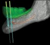 Figure 8  A-P spread in clinical situations. Providing a single premolar and a single molar (16.5 mm in length) in the distal cantilever requires approximately 10 mm A-P spread (X) to maintain a 1.5:1 relationship (Fig 7). The parallel placement of the implants resulted in approximately 4 mm to 5 mm of A-P spread (Fig 8). The divergent placement of the implants resulted in approximately 10 mm of A-P spread measured at the abutment/prosthesis interface (Fig 9).