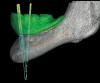 Figure 9: A-P spread in clinical situations. Providing a single premolar and a single molar (16.5 mm in length) in the distal cantilever requires approximately 10 mm A-P spread (X) to maintain a 1.5:1 relationship (Fig 7). The parallel placement of the implants resulted in approximately 4 mm to 5 mm of A-P spread (Fig 8). The divergent placement of the implants resulted in approximately 10 mm of A-P spread measured at the abutment/prosthesis interface (Fig 9).