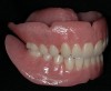 Figure 10  Conventional dentures.