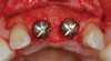 Figure 3  Periapical radiograph of implants in the Nos. 8 and 9 sites 3 years after placement. A bony peak was still present between the implants due to successful guided bone regeneration and favorable fixture spacing.