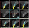 Figure 8  A CT scan was taken and virtual implant placement performed to ascertain if the patient was a candidate for immediate implantation.