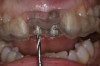 Figure 9: Initial view of resorbed maxillary central incisors.